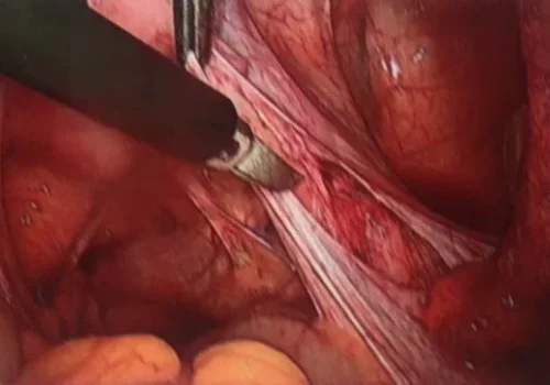The right pelvic side wall is dissected and endometriosis removed.