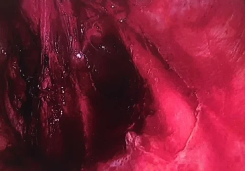 The right side wall endometriosis is excised. The right ureter has been dissected out