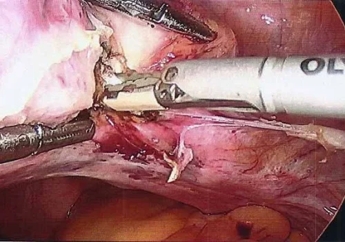 The right uterine artery has been dissected out and is being bipolared