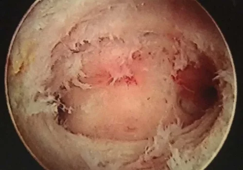 The uterine cavity at the end of the procedure. Openings of the tubes into the uterus are seen.