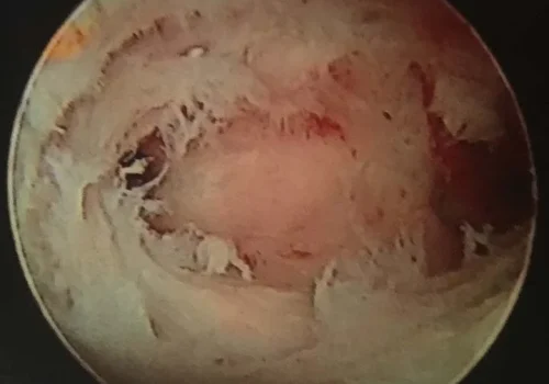 The uterine cavity is slowly opened up.