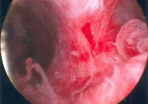 The uterine cavity – demonstrating the Uterine Septum