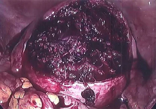 The uterus after the fibroid has been removed