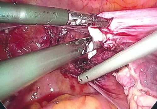 The uterus and cervix are detached from the vagina and removed.