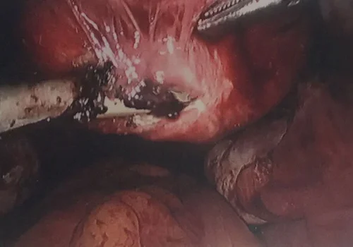 The uterus and cervix are detached from the vaginal cuff.