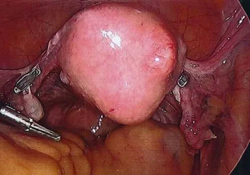 The uterus as seen at Laparoscopy. Filshie clips are noted. These were placed on the tubes many years before for sterilisation.