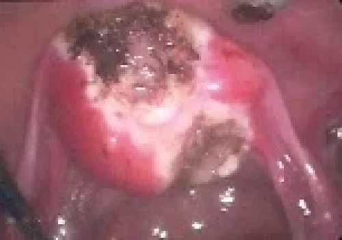 The uterus at the end after the adenomyoma is removed. Ongoing healing will continue