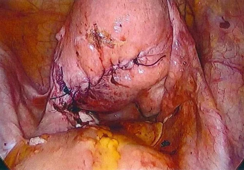 The uterus at the end of the procedure