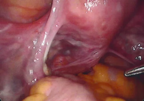 The uterus at the start of the procedure