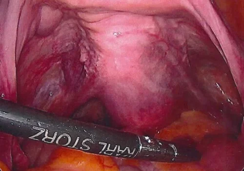 The uterus at the start of the procedure