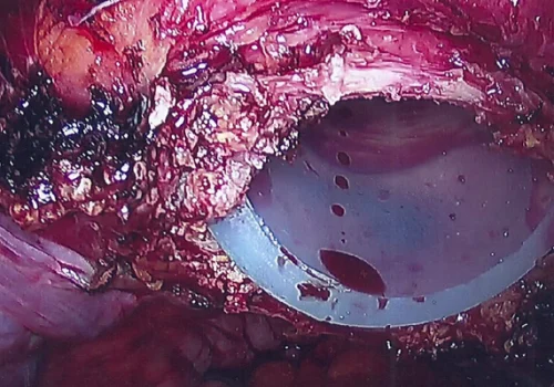 The uterus, both Fallopian Tubes and both Ovaries are detached from the vagina and removed through a vaginal tube