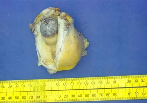 The uterus has been bisected and the cervical fibroid is seen.