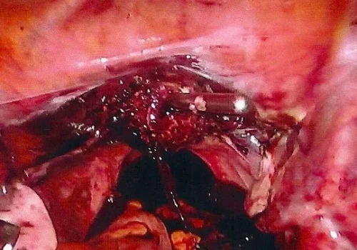 The uterus has been removed and the cervix remains