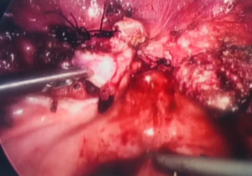 The uterus has been removed. The vault is sutured with interrupted sutures. The ovaries are preserved (not seen on this image)
