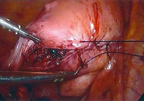 The uterus is closed in layers
