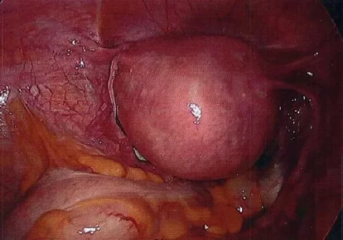 The uterus is seen laparoscopically
