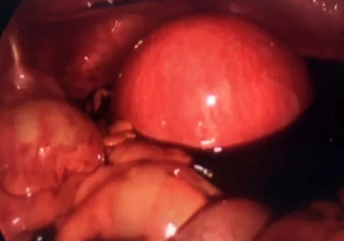 The uterus is surrounded by blood