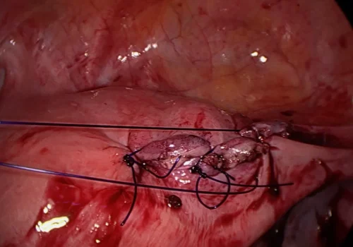 The uterus is sutured closed in layers laparoscopically