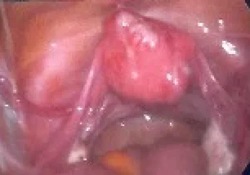 The uterus with a prominent area of irregularity at the top (adenomyoma)