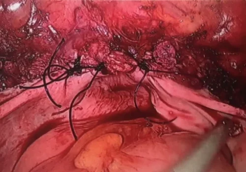 The vaginal vault at the end of the procedure. Both ovaries remain but cannot be seen in this image.