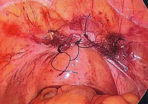 The vaginal vault at the end. The uterus, tubes and ovaries have been removed. The vaginal vault is closed with two sutures.