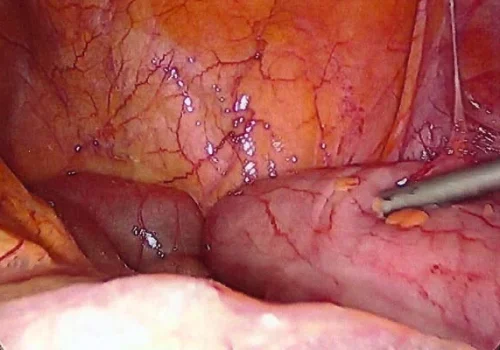 The vaginal vault at the start of the procedure.