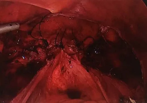 The vaginal vault has been closed with laparoscopic sutures.