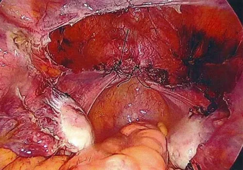The vaginal vault has been closed with two sutures. Both normal ovaries remain