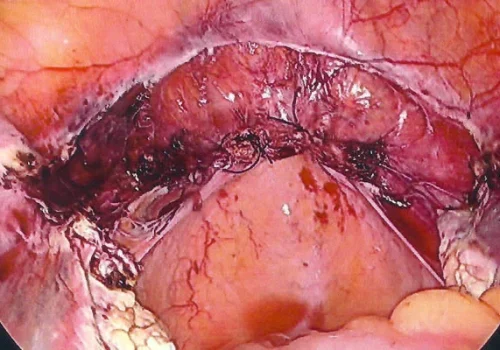 The vaginal vault has been sutured. The pelvis at the end of the procedure. Two normal ovaries are seen