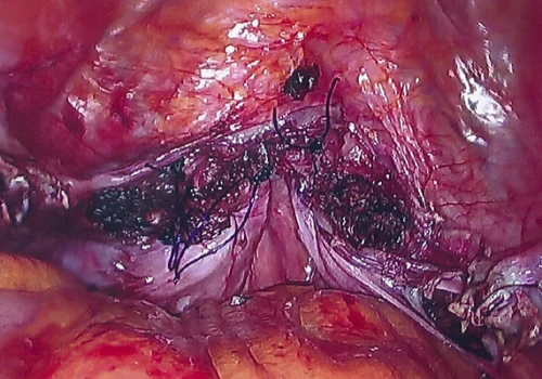 The vaginal vault is closed