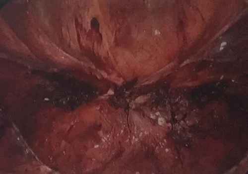The vaginal vault is closed. A normal pelvis at the end of the hysterectomy.