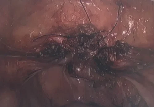 The vaginal vault - ready for the sling to be sutured.