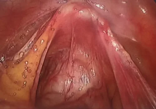 The vaginal vault seen at laparoscopy.