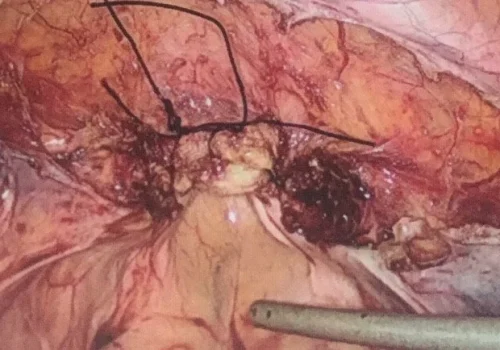 The vault has been closed laparoscopically.