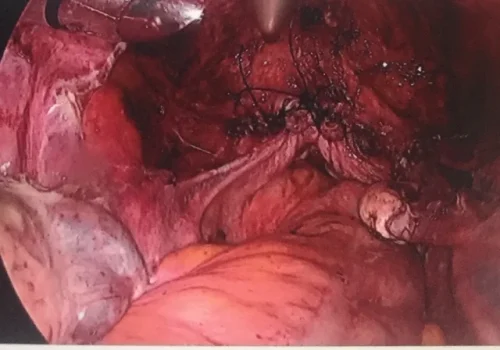 The vault is laparoscopically sutured. Two normal ovaries remain.