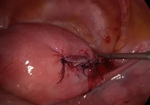 The view at the end. The fibroid has been removed and the uterus is sutured closed