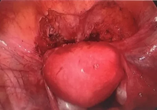 The view of the bladder at the end of the procedure.