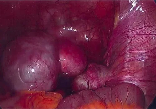 The view of the pelvis at laparoscopy showing extensive endometriosis. There is a 5cm left ovarian endometrioma.