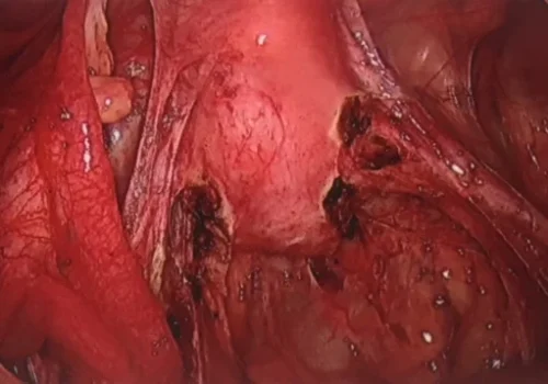 The view of the pelvis at the end of the procedure. All areas of recurrent endometriosis have been excised.