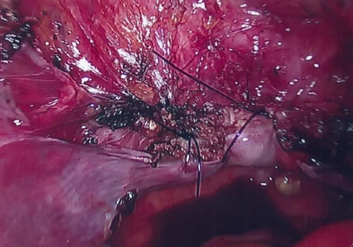The view of the vaginal vault at the end of the procedure
