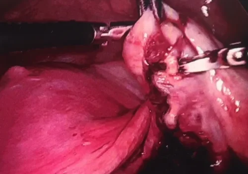The wall of the ovarian endometrioma is carefully stripped and normal ovarian tissue is preserved