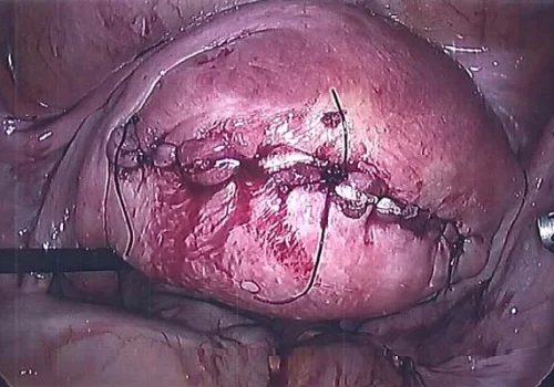 The walls of the uterus have been sutured closed
