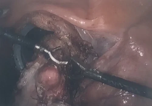 Total Laparoscopic Hysterectomy and removal of both tubes and ovaries.