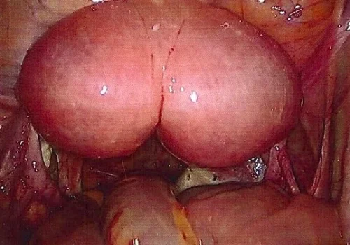 Uterine Didelphys