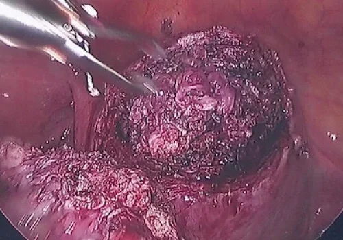 Uterus after fibroid removed