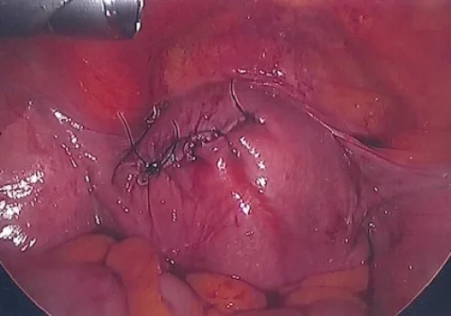 Uterus closed at end