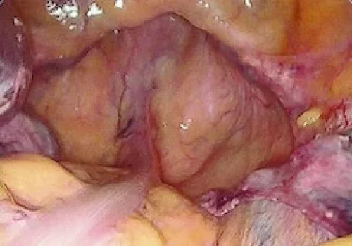 Vaginal prolapse seen laparoscopically