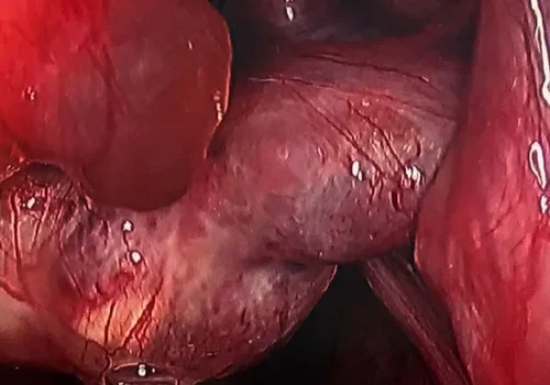 Very inflamed endometriosis and adhesions around the left tube and ovary are noted