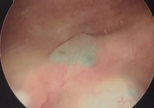 View of the bladder at cystoscopy. The pigmented endometriosis is seen invading through the bladder wall.