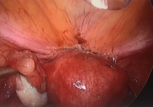 View of the bladder at laparoscopy. The pigmented and tented area is the bladder endometriotic nodule.